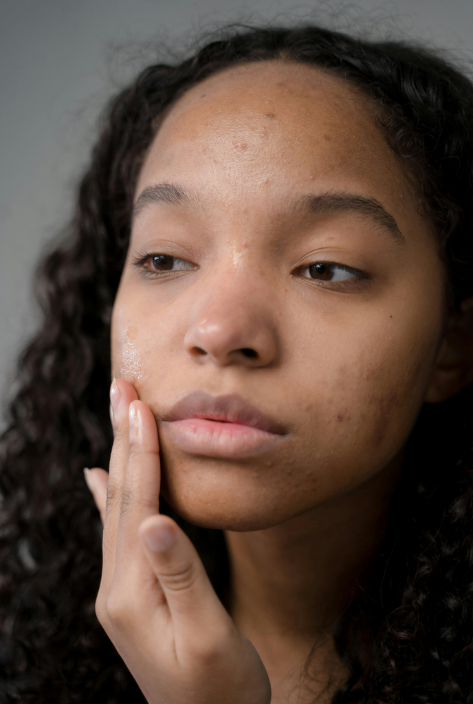 Skin Purging: What It Is, Why It Happens, and How to Deal with It