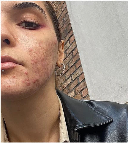 cystur-skinfluencers