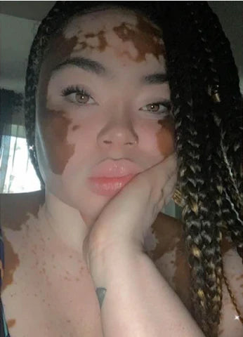 vitiligoqueen-skinfluencers